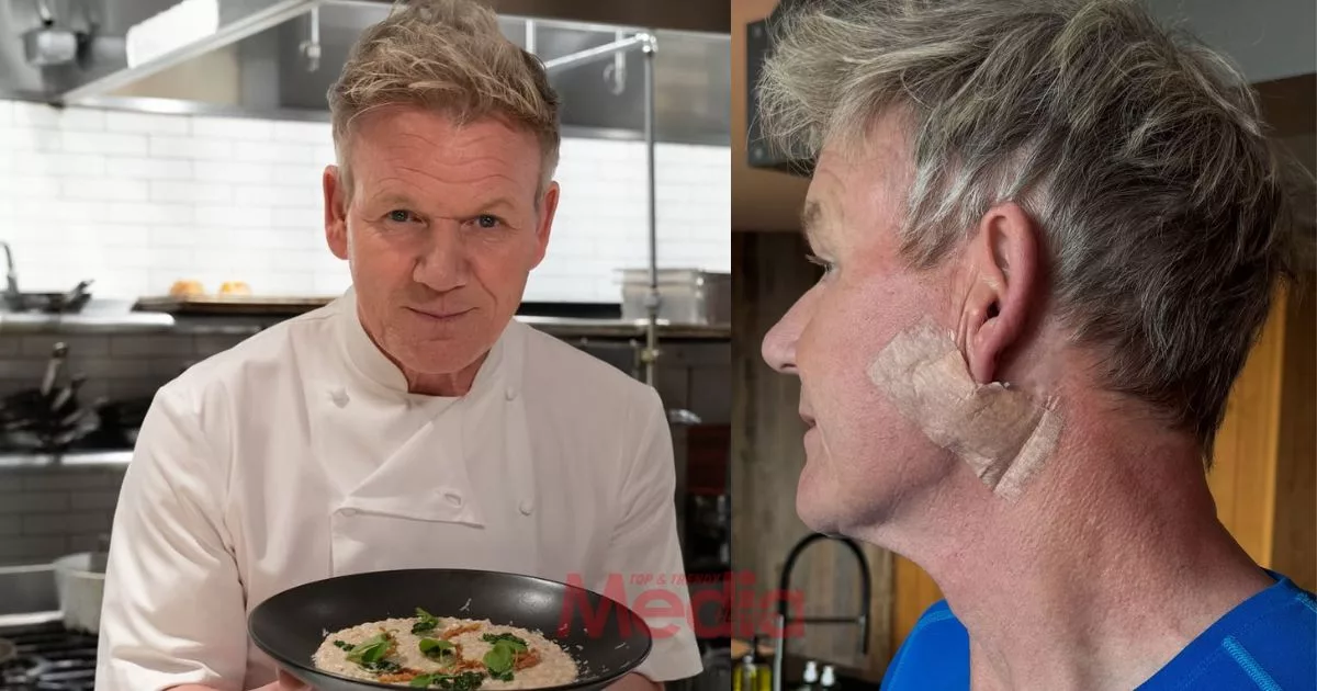 Gordon Ramsay Hidap Kanser Kulit, Jalani Pembedahan Buang Ketumbuhan 5 Gordon Ramsay Hidap Kanser Kulit, Jalani Pembedahan Buang Ketumbuhan