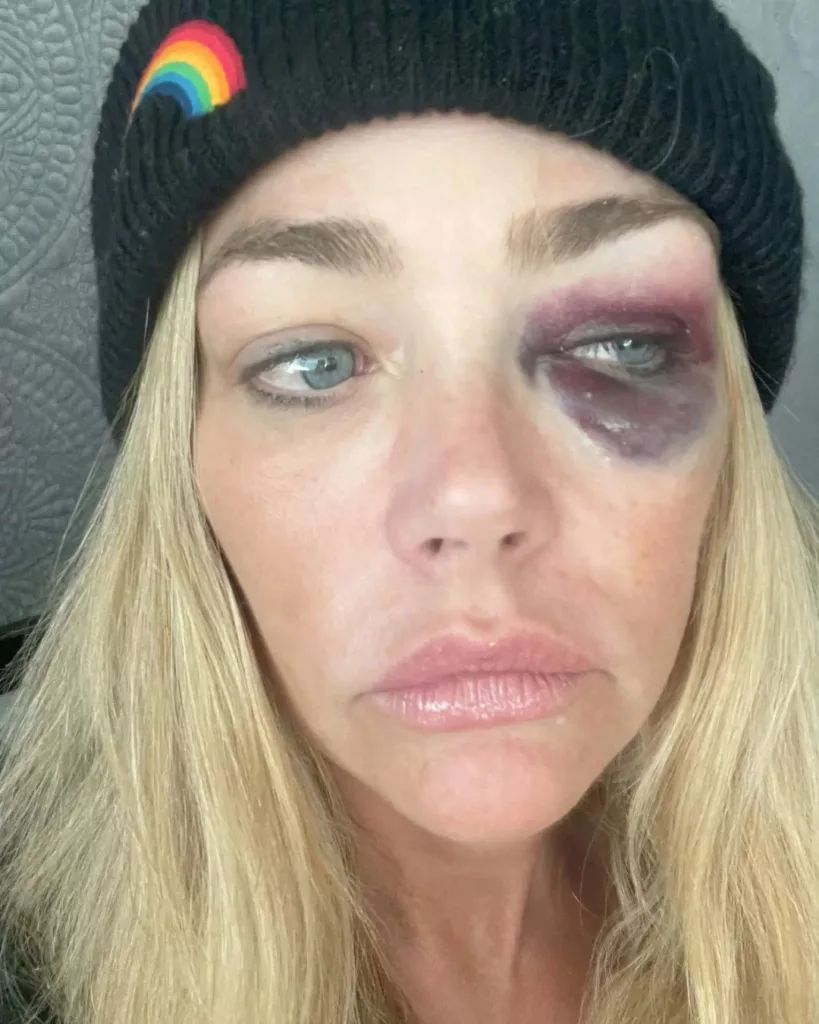 Aaron Phypers Nafi Tuduhan Penderaan Fizikal Terhadap Denise Richards