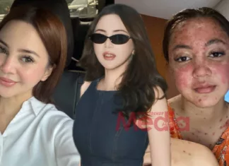 “Ya Tuhan, Fitnah…,” – Sharmaine Alexender Nafi Buat ‘Face Filler’, Wajah Berubah Sebab Kesan Ubat Psoriasis