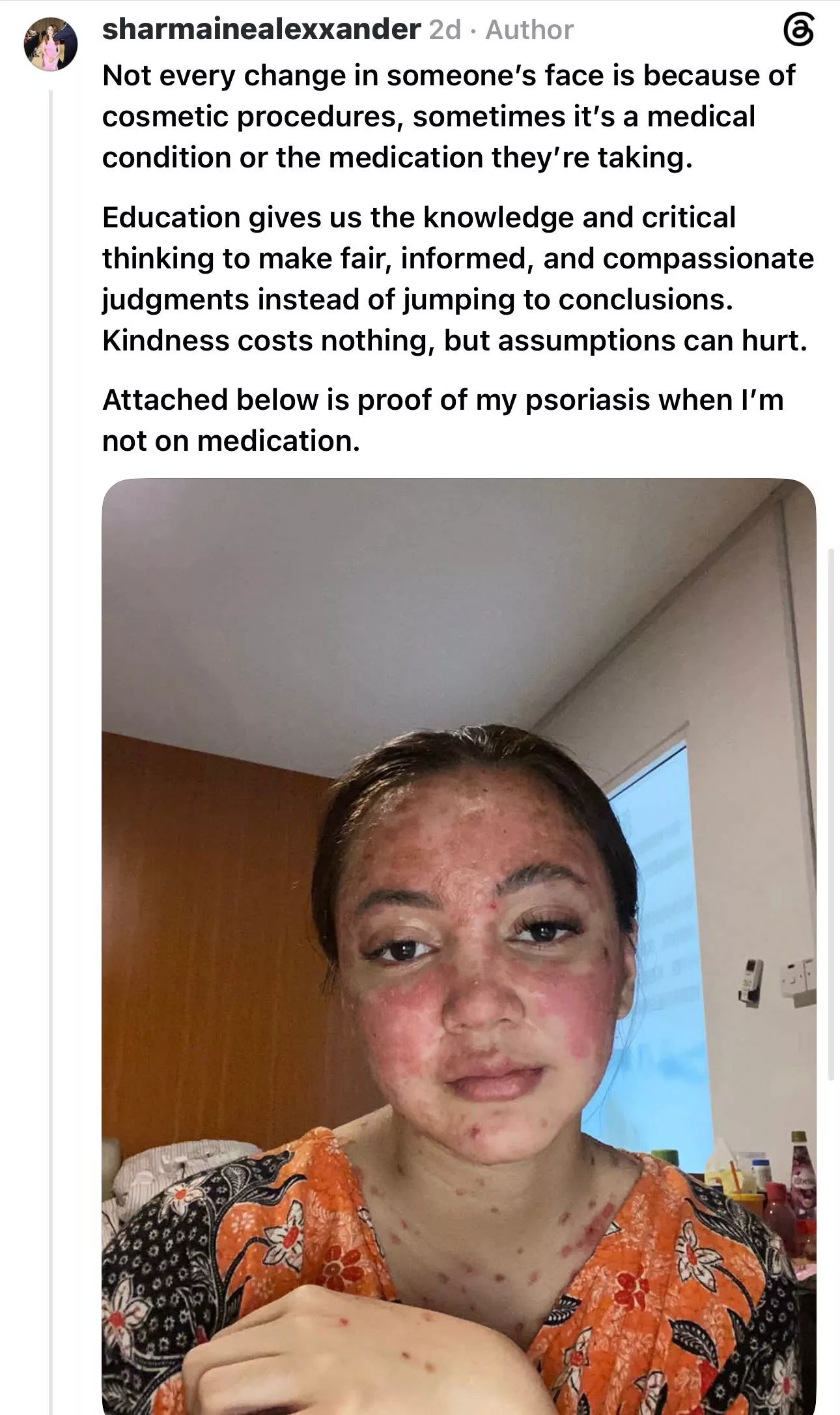 “Ya Tuhan, Fitnah…,” - Sharmaine Alexender Nafi Buat ‘Face Filler’, Wajah Berubah Sebab Kesan Ubat Psoriasis